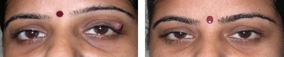Eyelid and Skin Cancer Reconstruction
